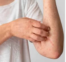 Best Allergies Ayurvedic Treatment in Dubai